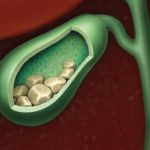 Sỏi mật có nguy hiểm không?