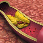 Máu nhiễm mỡ – Bệnh đơn giản nhưng “lấy mạng” như chơi