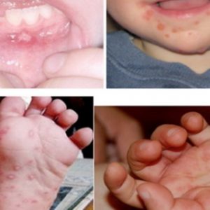 ​KHUYẾN CÁO PHÒNG BỆNH TAY CHÂN MIỆNG