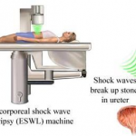 HÀ TRUNG: TÁN SỎI NGOÀI CƠ THỂ BẰNG SÓNG XUNG