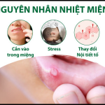 BỆNH NHIỆT MIỆNG