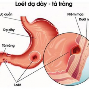 BỆNH VIÊM LOÉT DẠ DÀY TÁ TRÀNG