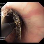 BỆNH VIỆN ĐA KHOA HÀ TRUNG NỘI SOI CAN THIỆP LẤY DỊ VẬT ĐƯỜNG TIÊU HÓA