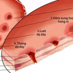 CHĂM SÓC NGƯỜI BỆNH SAU MỔ THỦNG DẠ DÀY