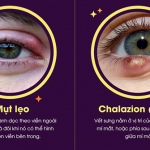 CHẮP VÀ LẸO MẮT