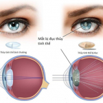 ĐỤC THỦY TINH THỂ