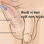 CHĂM SÓC NGƯỜI BỆNH SAU MỔ THOÁT BỊ BẸN