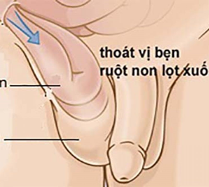 CHĂM SÓC NGƯỜI BỆNH SAU MỔ THOÁT BỊ BẸN 