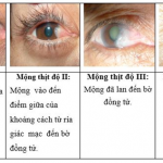BỆNH MỘNG THỊT