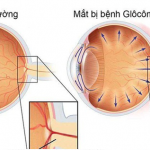 CHĂM SÓC BỆNH NHÂN SAU MỔ GLOCOM