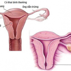 PHẪU THUẬT NỘI SOI ĐIỀU TRỊ CHỬA NGOÀI TỬ CUNG