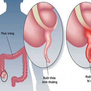 CHĂM SÓC NGƯỜI BỆNH SAU MỔ CẮT RUỘT THỪA VIÊM 