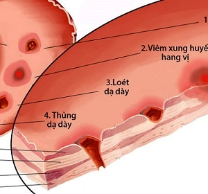 CHĂM SÓC NGƯỜI BỆNH SAU MỔ THỦNG DẠ DÀY 