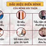CHĂM SÓC NGƯỜI BỆNH SAU MỔ SỎI  THẬN