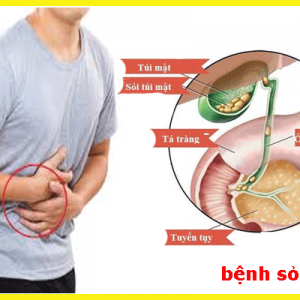 SỎI MẬT