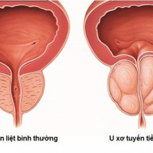 U XƠ TIỀN LIỆT TUYẾN 