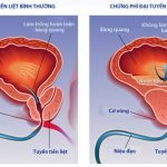 NỘI SOI CẮT U PHÌ ĐẠI LÀNH TÍNH TUYẾN TIỀN LIỆT