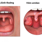 PHẪU THUẬT CẮT AMIDAN GÂY MÊ NỘI KHÍ QUẢN