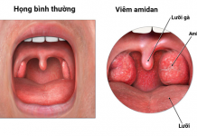 PHẪU THUẬT CẮT AMIDAN GÂY MÊ NỘI KHÍ QUẢN