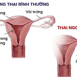CHĂM SÓC NGƯỜI BỆNH SAU MỔ CHỬA NGOÀI TỬ CUNG