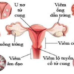 NHỮNG BỆNH PHỤ KHOA THƯỜNG GẶP VÀ CÁCH PHÒNG TRÁNH