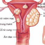CHĂM SÓC NGƯỜI BỆNH SAU MỔ CẮT U XƠ TỬ CUNG