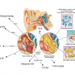 VIÊM TAI GIỮA CẤP TÍNH