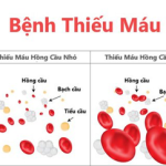 BỆNH THIẾU MÁU