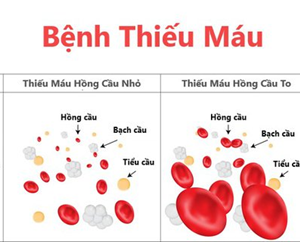 BỆNH THIẾU MÁU