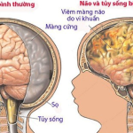 VIÊM MÀNG NÃO MỦ