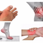 VIÊM ĐA KHỚP MẠN