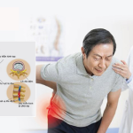 ĐAU THẦN KINH TỌA