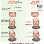 LIỆT THẦN KINH SỐ VII NGOẠI BIÊN