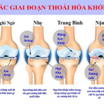 THOÁI HÓA KHỚP GỐI