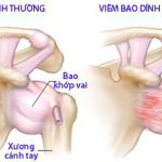 BỆNH VIÊM QUANH KHỚP VAI