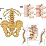 VIÊM CỘT SỐNG DÍNH KHỚP