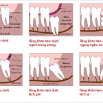 GIÁO DỤC SỨC KHỎE CHO BỆNH NHÂN NHỔ RĂNG KHÔN