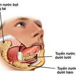 BỆNH VIÊM TUYẾN NƯỚC BỌT MANG TAI