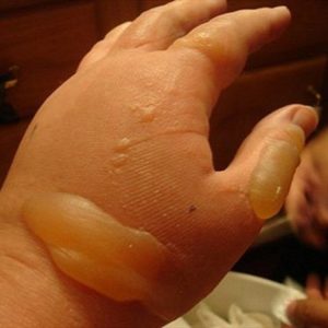 CHĂM SÓC KHI TRẺ BỊ BỎNG