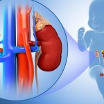 VIÊM CẦU THẬN CẤP