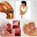 BỆNH THẤP KHỚP CẤP (THẤP TIM)