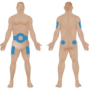 TIÊM INSULIN TẠI NHÀ ĐÚNG CÁCH TRÁNH BIẾN CHỨNG