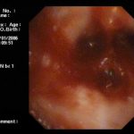 NỘI SOI KHÍ PHẾ QUẢN TẠI BVĐK HÀ TRUNG