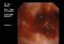 NỘI SOI KHÍ PHẾ QUẢN TẠI BVĐK HÀ TRUNG