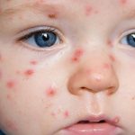 CÁCH CHĂM SÓC ĐÚNG KHI TRẺ MẮC THỦY ĐẬU ĐỂ TRÁNH BỊ SẸO