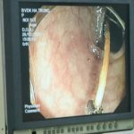 BỆNH VIỆN ĐA KHOA HÀ TRUNG: THỰC HIỆN THÀNH CÔNG CA GẮP DỊ VẬT ĐẠI TRÀNG