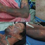 CÔNG VĂN SỐ 226/DP-DT TĂNG CƯỜNG PHÒNG, CHỐNG BỆNH LIÊN CẦU LỢN TRÊN NGƯỜI