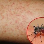 WHO HƯỚNG DẪN NHẬN BIẾT TRIỆU CHỨNG VÀ ĐIỀU TRỊ BỆNH SỐT XUẤT HUYẾT