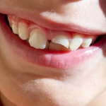 CHẤN THƯƠNG RĂNG SỮA Ở TRẺ XỬ TRÍ THẾ NÀO?