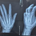 ĐIỀU TRỊ THÀNH CÔNG CA “GÃY XƯƠNG BÀN TAY” CHO BỆNH NHÂN 21 TUỔI